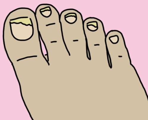 什么样的人更容易感染灰指甲？